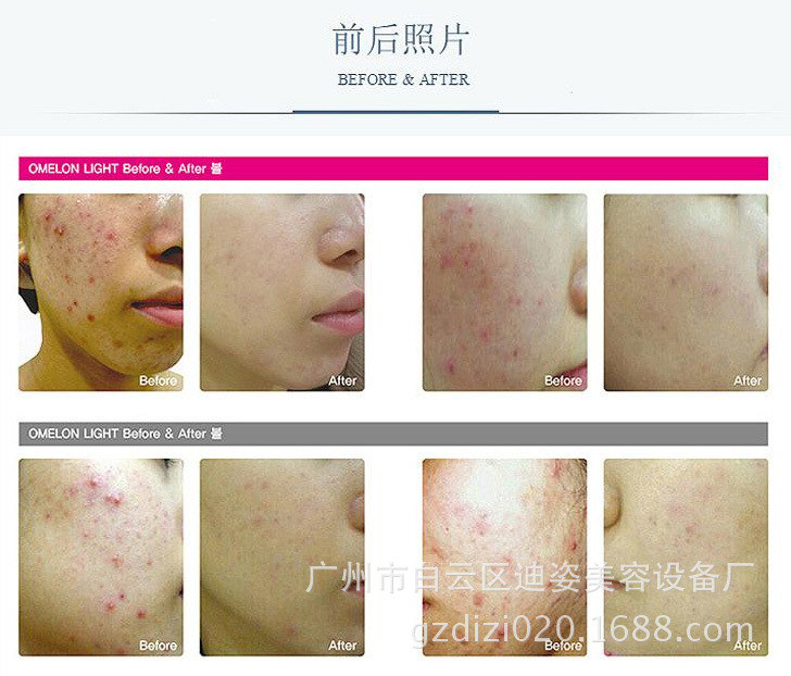 厂家新款韩国皮肤管理光动力美容仪美白淡斑红蓝光光动力美容仪示例图9